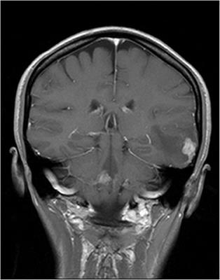 A Case Report of a Female Patient With Hodgkin Lymphoma Localized in the Central Nervous System and With Concomitant Pulmonary Lymphomatoid Granulomatosis